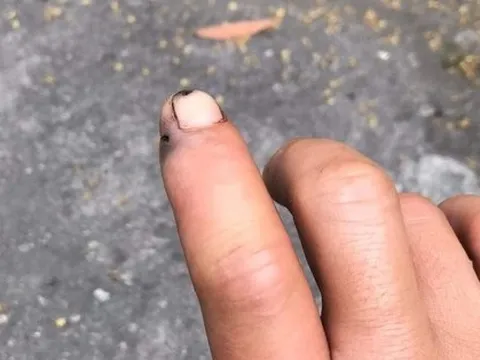 Bị rắn cắn, người đàn ông mang cả đầu rắn đến bệnh viện trong đêm