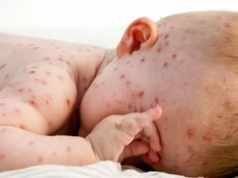 Ca mắc thủy đậu tại Hà Nội tăng cao, Bộ Y tế gia tăng khuyến cáo