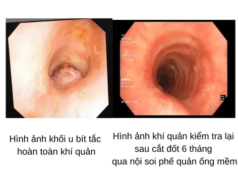 Bệnh hay gặp ở màng nhầy đường sinh dục nhưng lại xuất hiện ở khí quản cô gái 17 tuổi