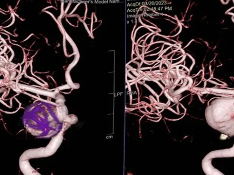 Tử vong tức tưởi vì túi phình trong đầu vỡ ra