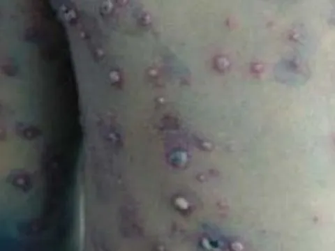 Bệnh thủy đậu xuất hiện tại nhiều trường học