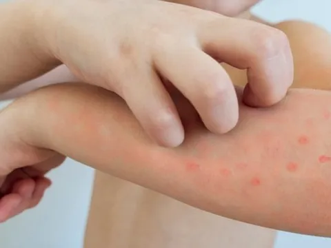 Bệnh thủy đậu ‘tấn công’ nhiều trường học: Cách nhận biết dấu hiệu sớm của bệnh mà cha mẹ nào cũng cần biết