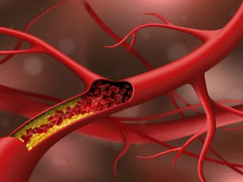Cholesterol cao: Thêm nguyên nhân bất ngờ, không liên quan ăn uống