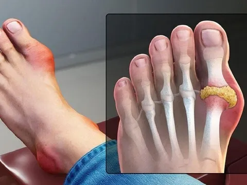 Đắp lá trộn muối chữa gout, nam bệnh nhân mất ngón chân