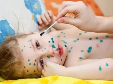 Chăm sóc trẻ bị thủy đậu đúng cách tránh các biến chứng nguy hiểm
