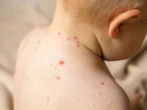 Con có những dấu hiệu này mẹ cần cho con đi khám gấp vì nguy cơ bị thủy đậu