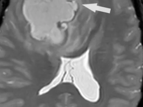 Khối u 5 cm trốn trong não nữ bệnh nhân Campuchia