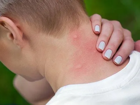 Cách phân biệt các vết đốt của côn trùng