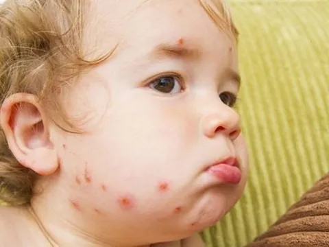Cách chăm sóc trẻ bị thủy đậu tại nhà để phòng biến chứng và không bị sẹo