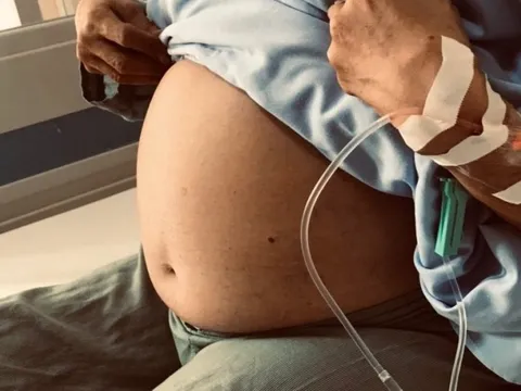 Người phụ nữ U60 bụng to bất thường