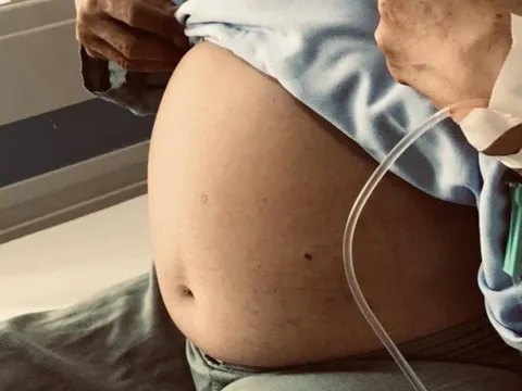 Tưởng béo bụng nên chủ quan không đi khám, cụ bà 'tá hỏa' phát hiện khối u gần 10kg trong người