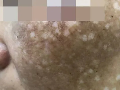 Học bí quyết trị nám bằng lá trầu trên Tik Tok, 4 người phụ nữ nhận hậu quả nặng nề