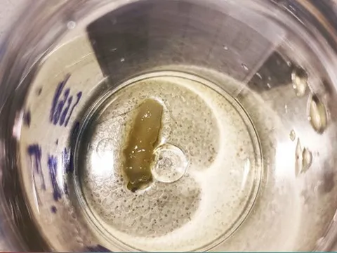 Ăn thịt bò tái, cô gái bị nhiễm sán dây bò