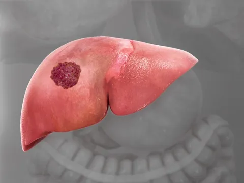 9 dấu hiệu nhận biết ung thư gan sớm nhất và chính xác nhất