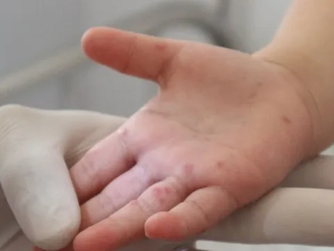 Chủ động phòng, chống bệnh tay chân miệng