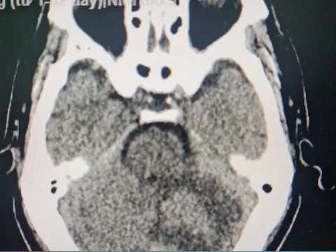 Đột ngột đau đầu, mất cân bằng, đi viện phát hiện khối u não