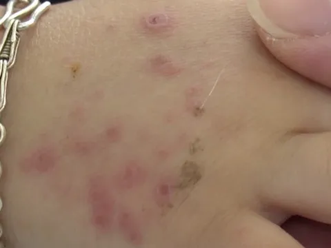 Bệnh tay chân miệng đang vào mùa - Cha mẹ lưu ý để bệnh không trở nặng