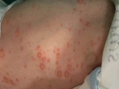 Lây thủy đậu từ mẹ, bé sơ sinh bị biến chứng nặng