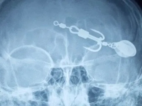 Xem câu cá, bé trai 13 tuổi bị lưỡi câu móc vào mắt