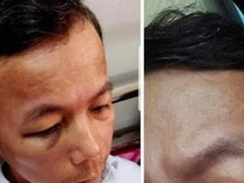 Quảng Bình: Hiệu trưởng đánh hiệu phó nhập viện