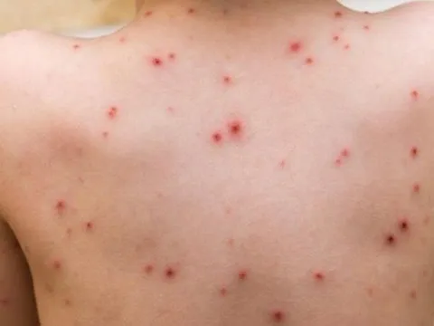 Hà Nội: Dịch thủy đậu bùng phát mạnh, sắp chạm ngưỡng 1.000 ca