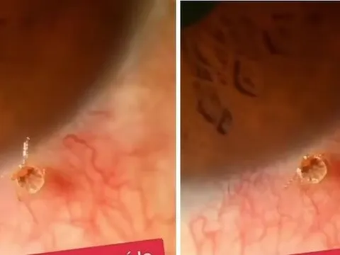 Đi khám vì ngứa mắt, phát hiện 'thủ phạm' không ngờ tới