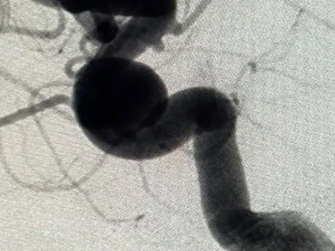 Suýt mất mạng vì chứng đau đầu