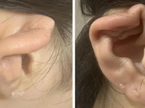 Nữ sinh 15 tuổi xỏ lỗ tai gây viêm màng sụn, biến dạng vành tai, chuyên gia cảnh báo