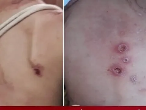 Bé trai ở TP.HCM có dấu hiệu bị bạo hành: Bệnh trạng còn nặng, tiếp tục hồi sức