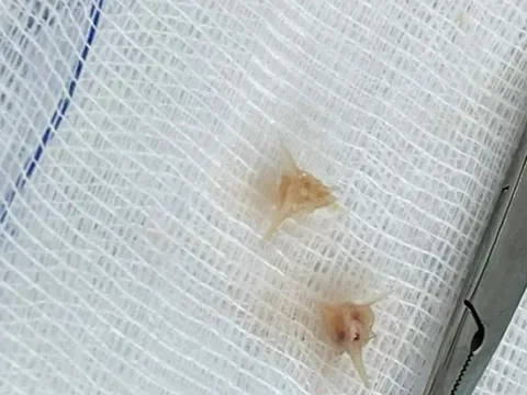 Bé gái 10 tháng tuổi nôn, sốt, ho… do mảnh xương lươn