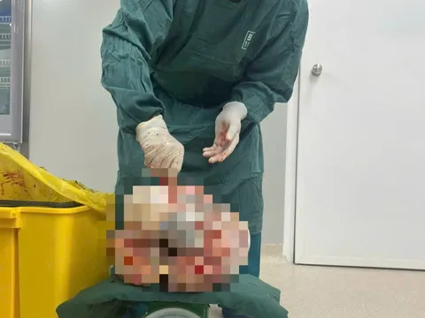 Người phụ nữ có khối bướu nặng gần 9 kg trong bụng vì bỏ điều trị