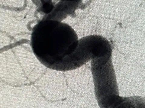 Thay đổi dòng chảy, ngăn kịp bom nổ trong đầu người phụ nữ