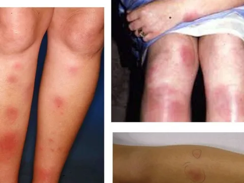 Căn bệnh hay gặp ở các chị em 20-30 tuổi khiến da sẩn cục, nóng đỏ