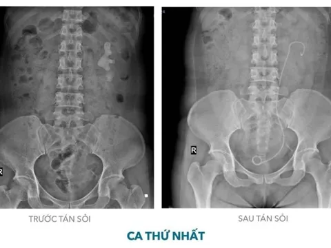 Khánh Hòa: Tán sỏi san hô qua da bằng đường hầm nhỏ cho 2 bệnh nhân