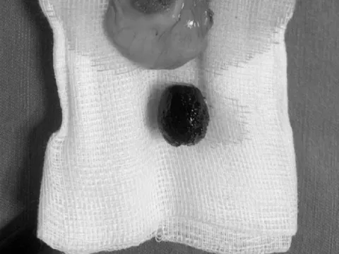 Phẫu thuật lấy sỏi túi mật thành công cho cụ bà 87 tuổi