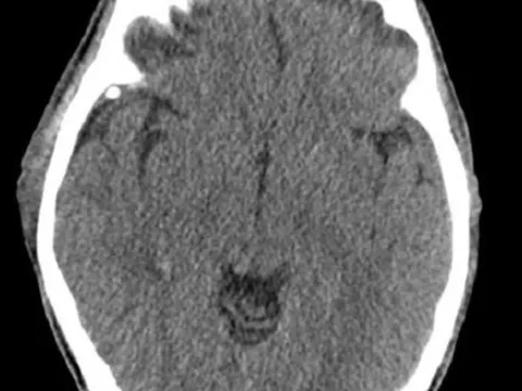 Chủ quan sau khi bị ngã, người đàn ông phải mổ cấp cứu vì máu tụ