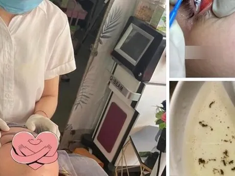 Dịch vụ bắt 'sâu mắt', 'sán mắt' tại các spa khiến nhiều chị em hứng thú, chuyên gia cảnh báo 3 sự thật