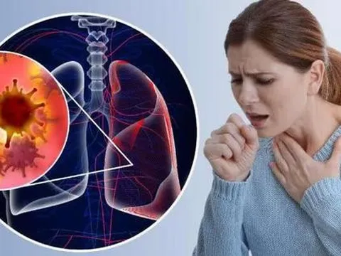 3 triệu chứng nghiêm trọng cảnh báo ung thư phổi