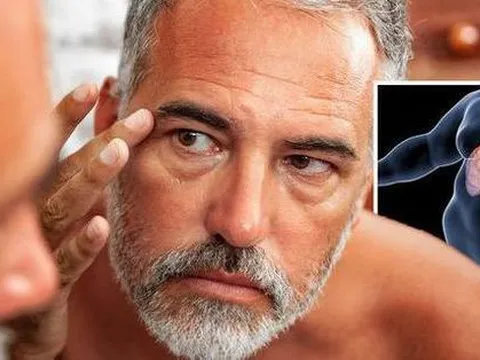 Thấy 6 dấu hiệu này trên khuôn mặt, hãy cẩn thận với gan nhiễm mỡ