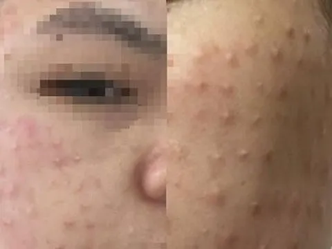 Mặt nổi u hạt chi chít như "da cóc" sau buổi tiêm làm đẹp da miễn phí