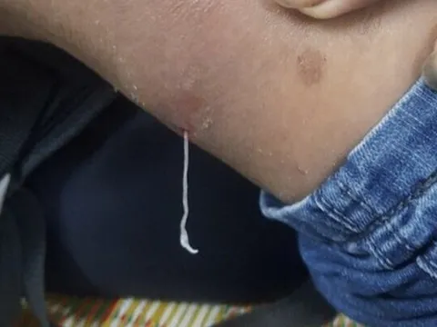 Ổ giun rồng 0,7-1,2 m chui ra từ khối sưng nề trên cơ thể