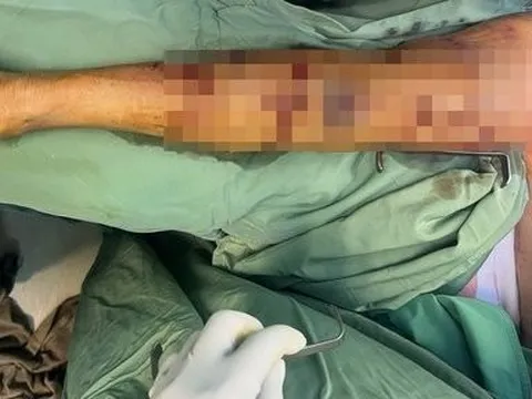 BR-VT: Cứu kịp thời bệnh nhân bị chó cắn gây đa vết thương khắp cơ thể