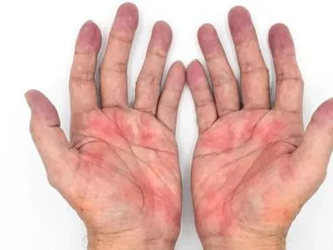 Thấy 3 dấu hiệu này ở bàn tay, có thể bạn đang mắc gan nhiễm mỡ nặng