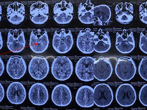 Cứu chồng bị nhồi máu não, vợ dùng vật nhọn chích đầu ngón tay, chân mà không ngờ hậu quả