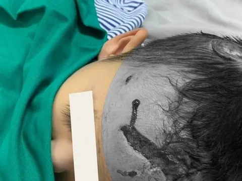 Bị chó nhà tấn công, bé trai 23 tháng tuổi nhập viện với nhiều vết thương vùng đầu, mặt