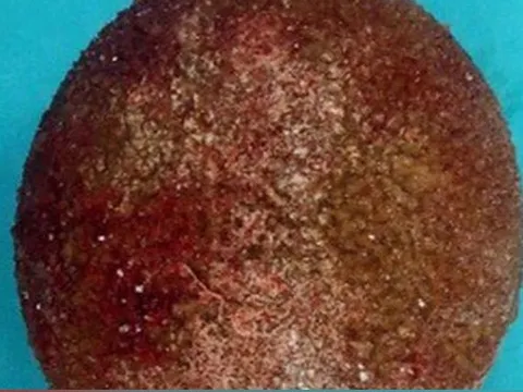 Lấy viên sỏi to như quả trứng trong bàng quang bệnh nhân