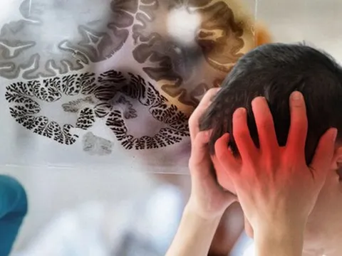 3 dấu hiệu có thể là tín hiệu cảnh báo teo não, lão hóa não càng nghiêm trọng