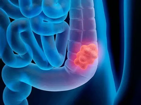 Bác sĩ 37 tuổi phát hiện ung thư đại tràng giai đoạn 4 nhờ 1 dấu hiệu "lạ kỳ"