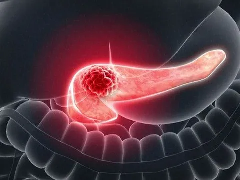 2 triệu chứng sớm cảnh báo ung thư tụy xuất hiện trước đó tới 1 năm