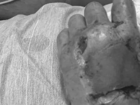 Nhập viện với mu bàn tay bị hoại tử sau 7 ngày đắp thuốc chữa rắn cắn